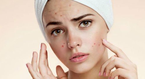 Pesquisadores brasileiros descobrem causa genética para acne na mulher adulta