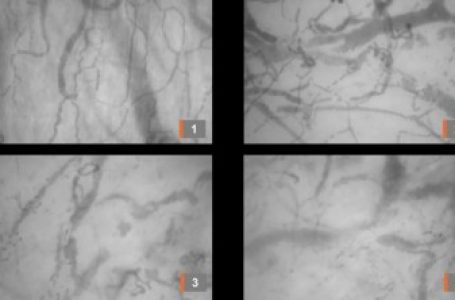 COVID-19: Estudo registra ao vivo formação de coágulos em vasos sanguíneos de pacientes